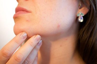 acne mikrovelonismos physicaltherapies